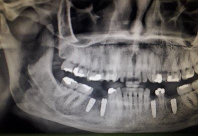 Evos Implant