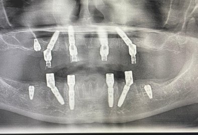 Evos Implant