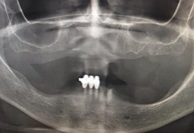 Implant Case