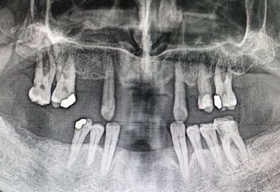 Implant Case